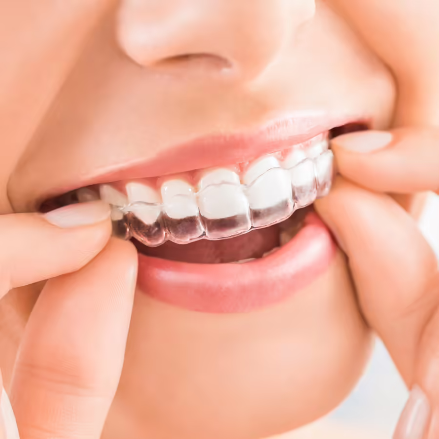 Dental Aligners