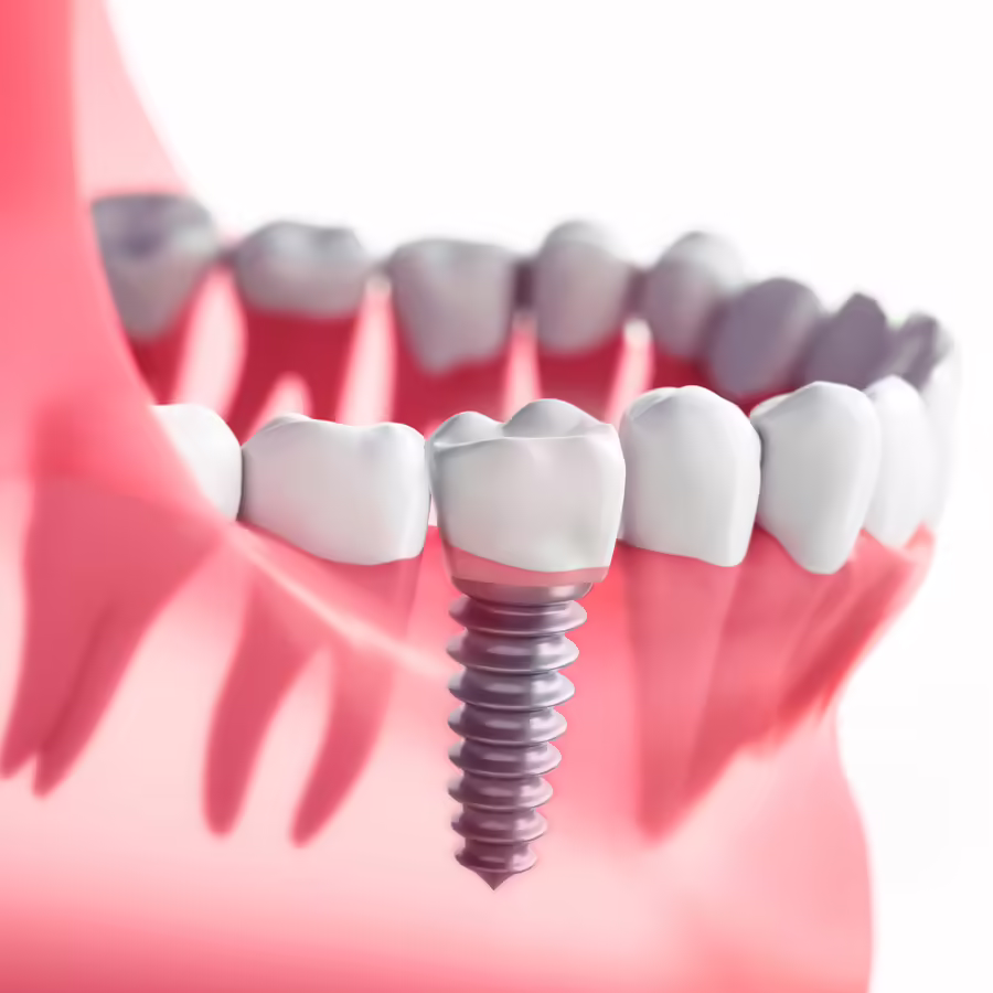 Dental Implants