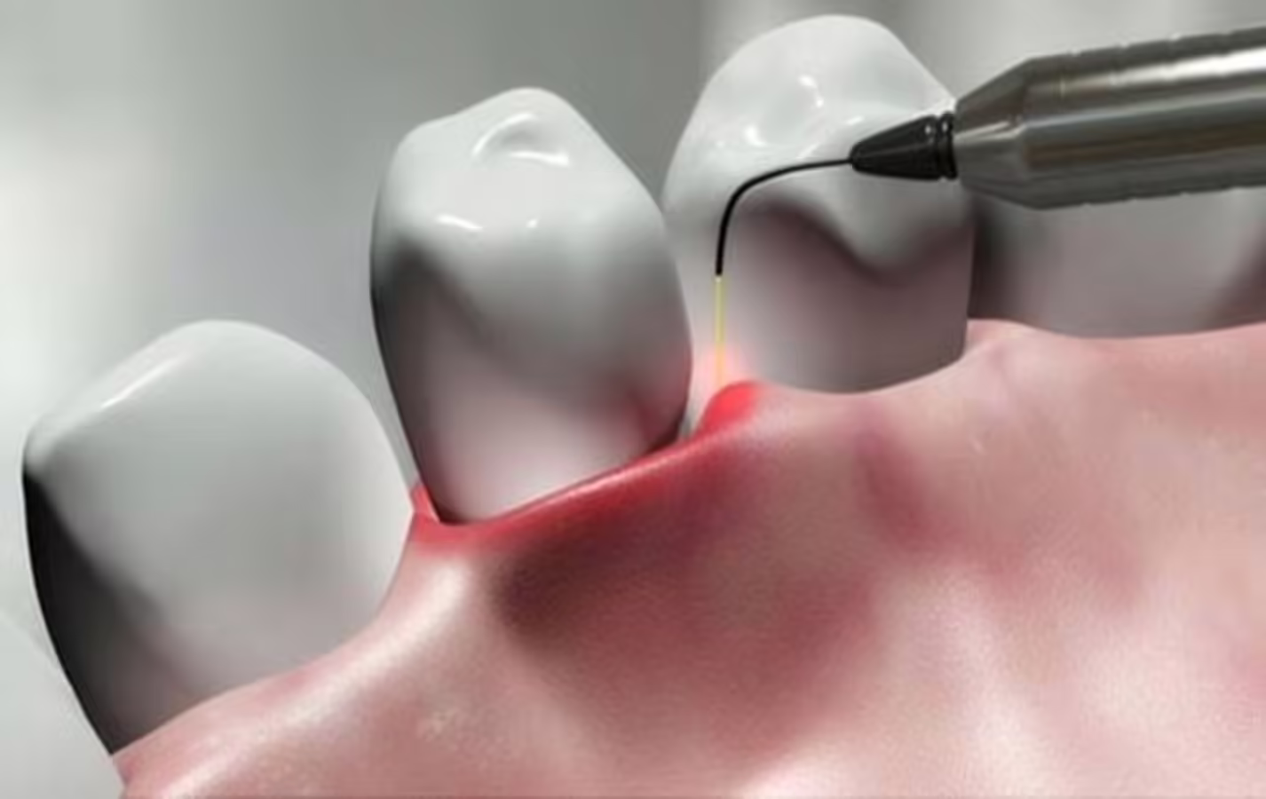 Advanced Laser Treatment