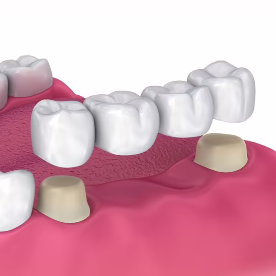 Porcelain Crowns