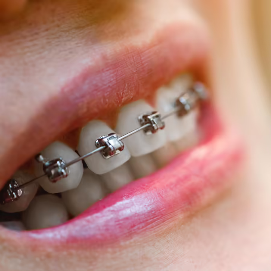 Self Ligating Braces