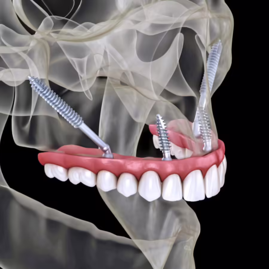 Zygomatic implant procedure
